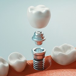 Digital image of the dental implant parts