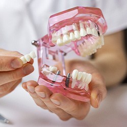 Dentist holding dental bridge to place on top of implants