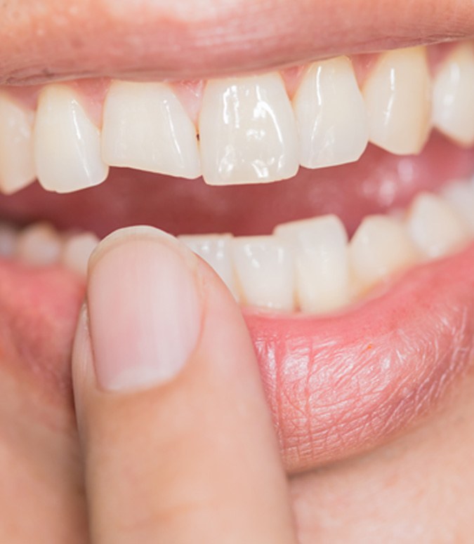 Closeup of a chipped tooth