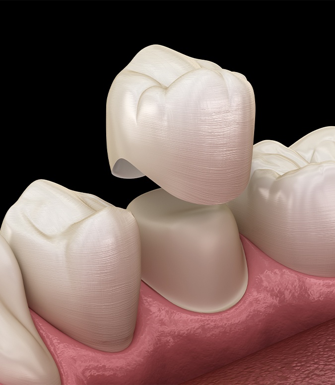 Animated dental crown placement during restorative dentistry treatment