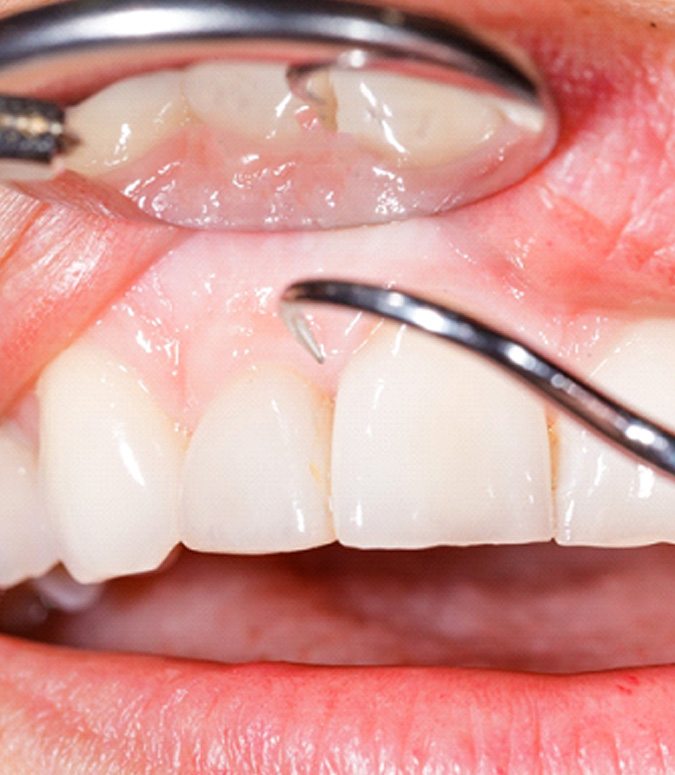 Close up of dental cleaning