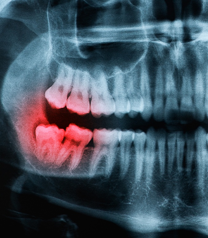 X-ray of smile with impacted wisdom tooth before extractions