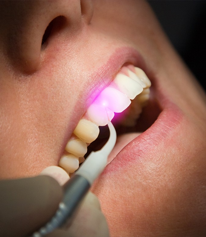 Closeup of smile during laser periodontal therapy