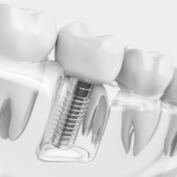 Animated smile with dental implant supported dental crown