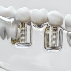 Animated smile with dental implant supported fixed bridge