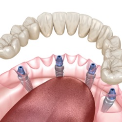 Animated smile during all on four dental implant supported denture placement