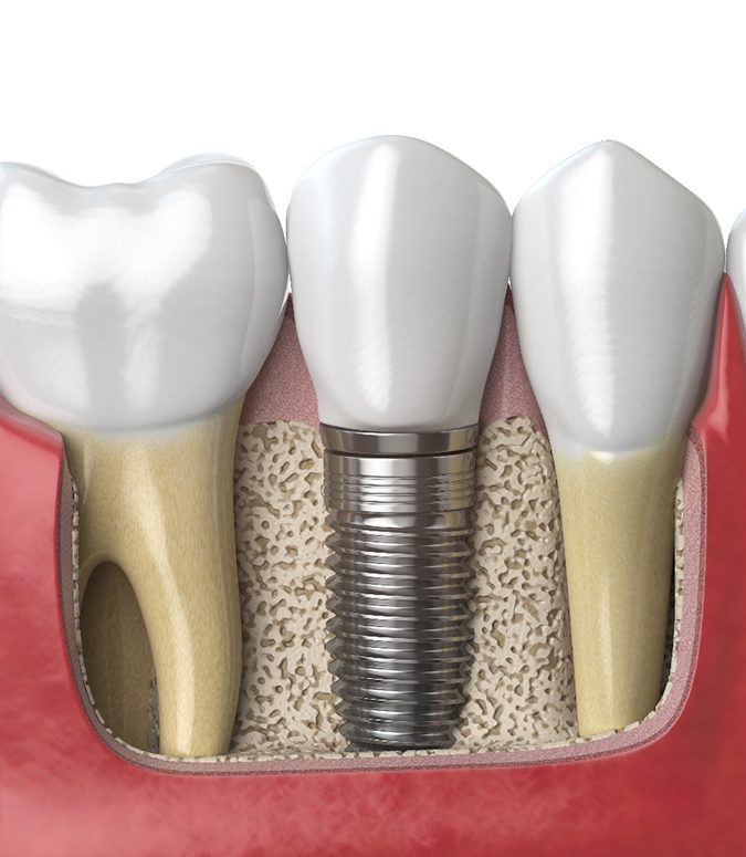 Illustration of dental implant; dental implant failure and salvage in Englewood, FL