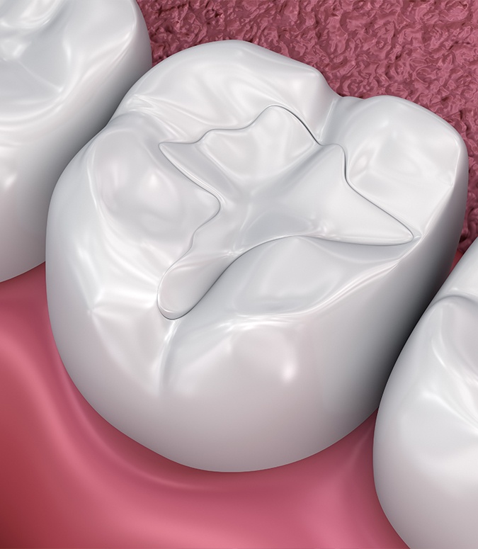 Animated smile after metal free dental restorations