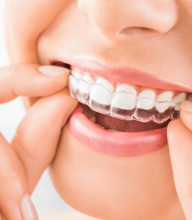 Close up of woman taking out Invisalign in Englewood