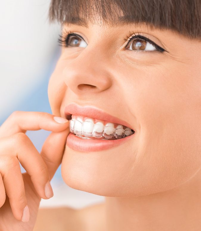 Woman with brown hair putting in her clear aligner on upper teeth 
