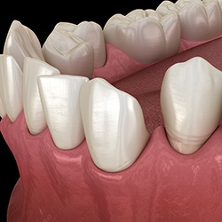 Illustration of gapped teeth