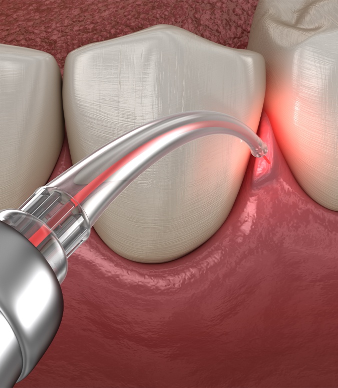 Animated smile during soft tissue laser therapy