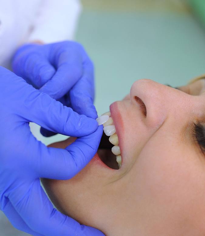 Dental veneers against a black background