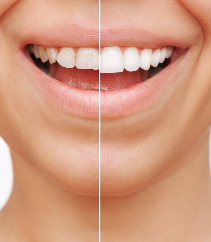 A woman receiving dental veneers