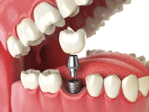 3D render of a dental implant