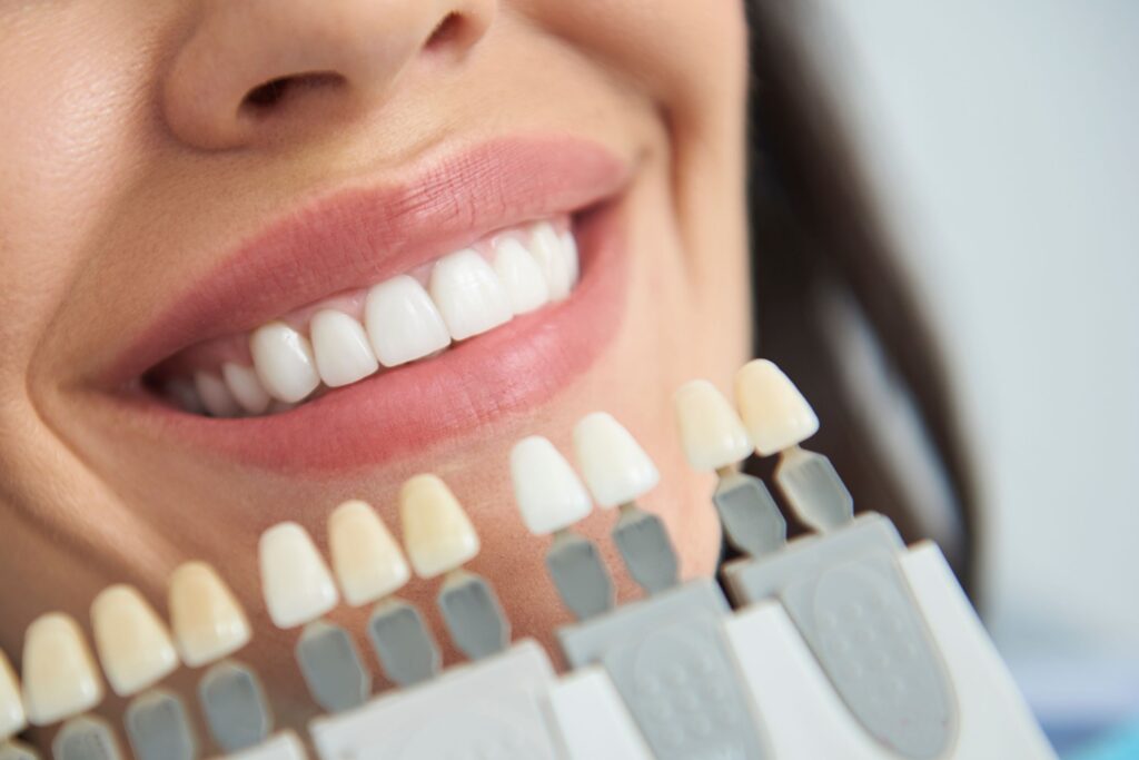 Nose-to-chin view of woman smiling with shade guide held to teeth